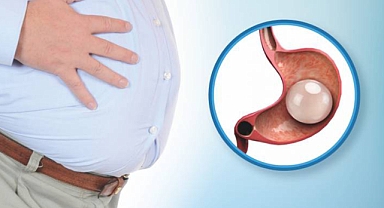 Obeziteye karşı ameliyatsız yöntem: Mide balonu