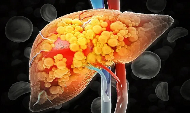 Karaciğer yağlanmasına karşı 10 etkili önlem!