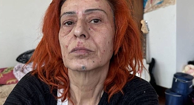 Şarkıcı Yıldız Tilbe'nin yüzü yandı!