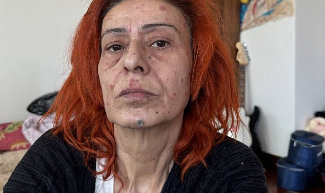 Şarkıcı Yıldız Tilbe'nin yüzü yandı!